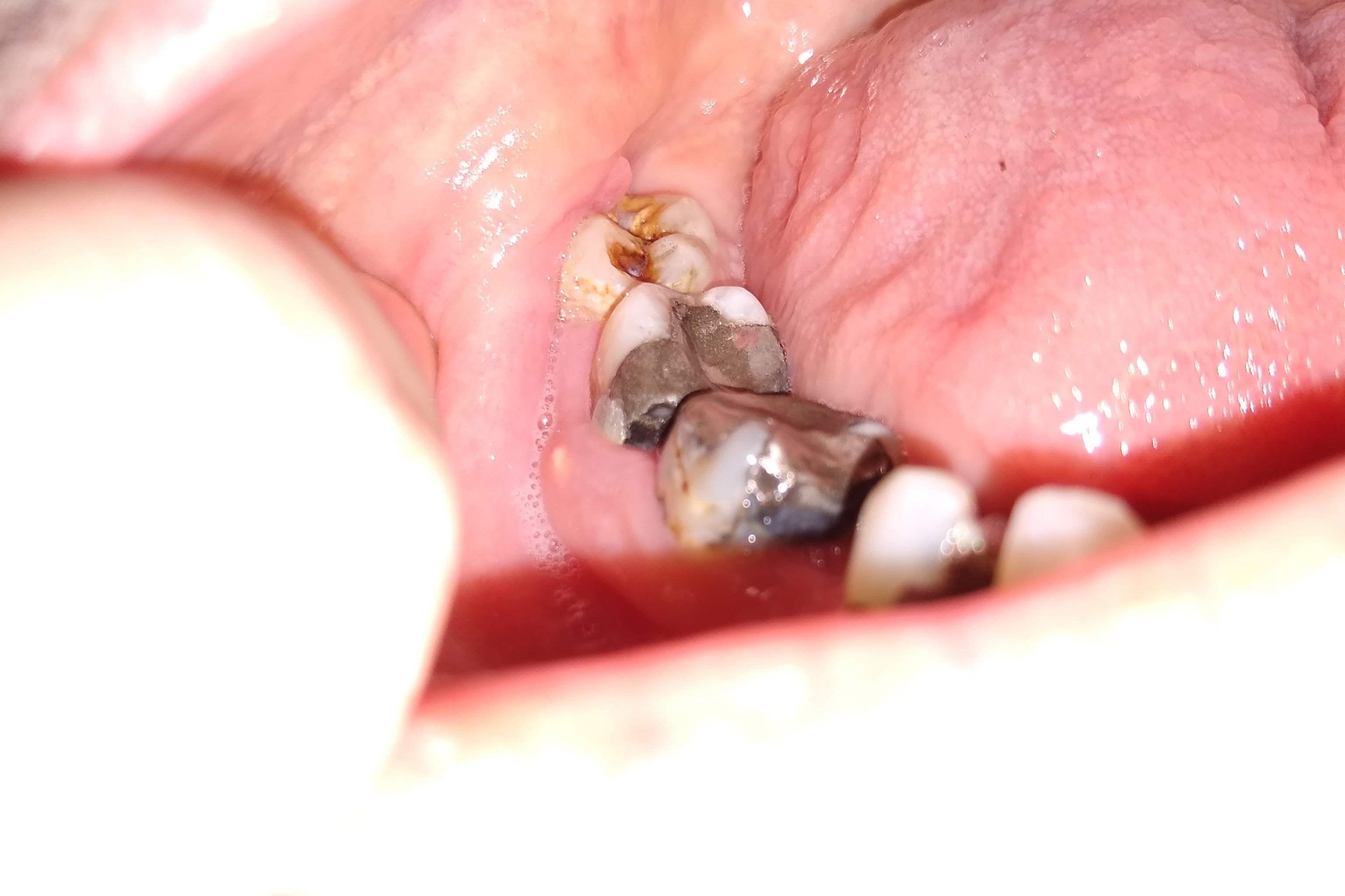Reoccurring gum boils feels like no one can figure out root issue