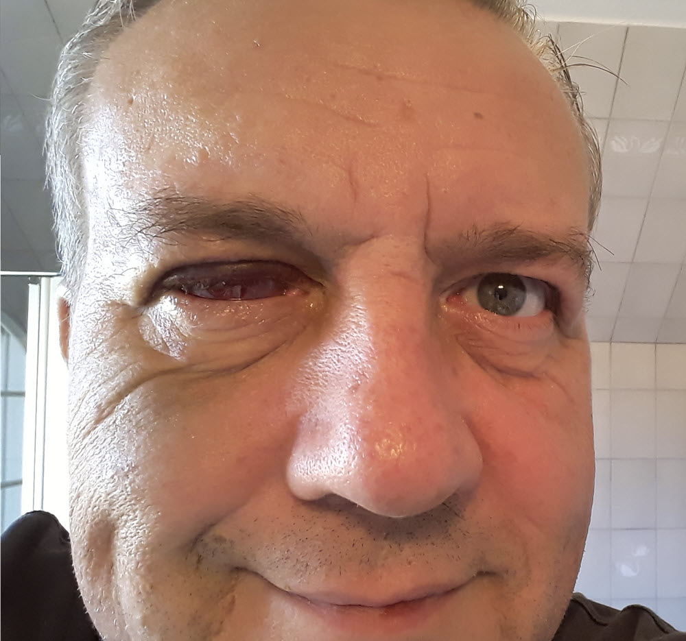 rechtesaugetag9nachopseptember2020.jpg aus dem Album Enukleation